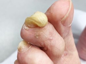 severe overgrown toenails