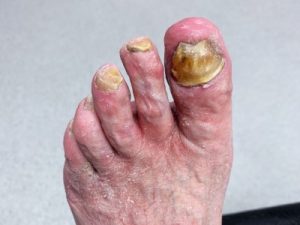 after photo of nail trimming