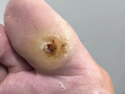 diabetic toe ulcer