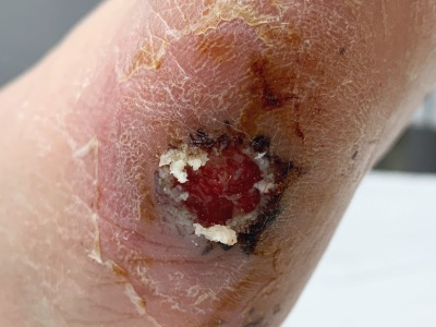 diabetic foot ulcer