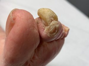 severe overgrown toenails