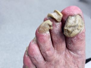 severe overgrown toenails