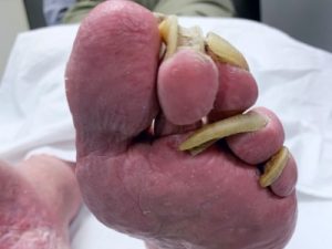 severe overgrown toenails