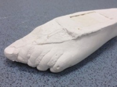positive cast from casting a foot orthotic