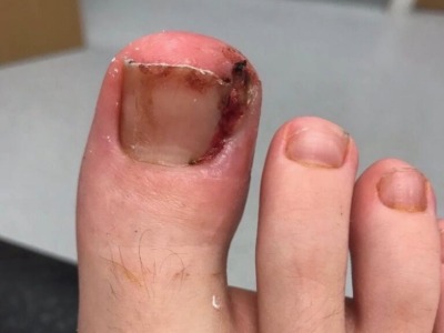 Ingrowing toenail - sore