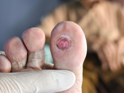 Medical examples of diabetic feet
