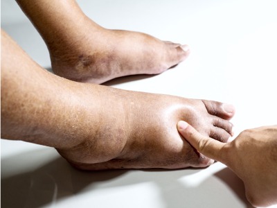 Medical examples of diabetic feet