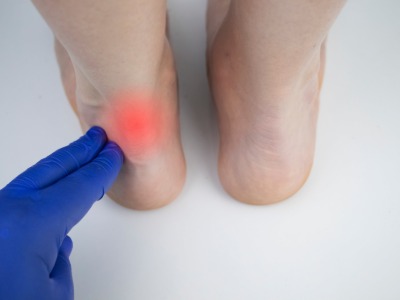 Achilles Tendinopathy: Expert Treatment in Leeds