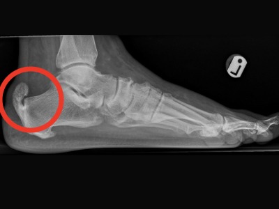 Achilles xray image