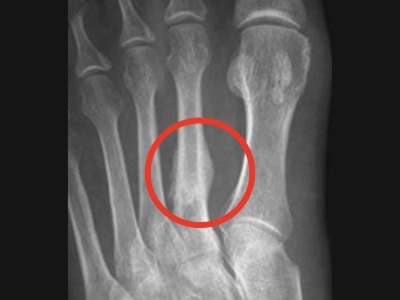 xray of foot with ring around painful area representing Forefoot pain treatment Leeds