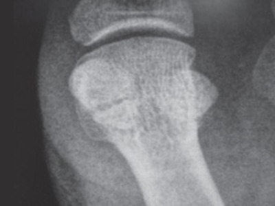 X-ray close-up of foot bone representing Forefoot pain treatment Leeds