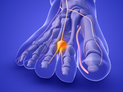 computer-generated fott showing the inner workings and where pain is represented Forefoot pain treatment Leeds