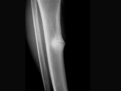 xray of Shin pain treatment Leeds