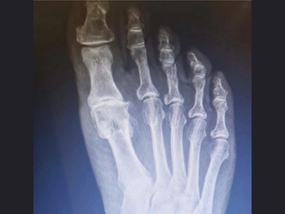 Hallux limitus joint space severely narrowed