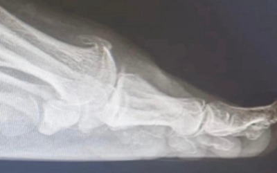 Hallux limitus showing dorsal spur on top of joint