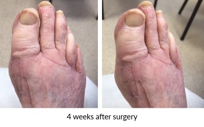 image of Hallux rigidus and bunion  4 weeks post-surgery
