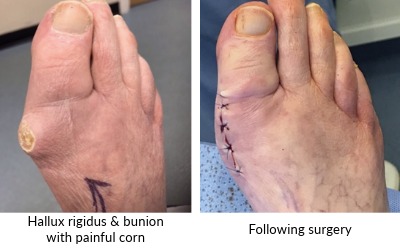 image of Hallux rigidus and bunion 
with painful corn pre and post surgery
