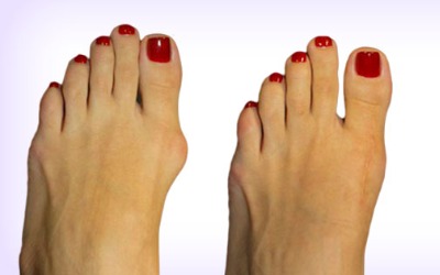 before and after Bunion (Hallux Valgus) Assessment and Treatment in Leeds