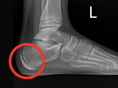 xray of foot with circle highlighting the pain area Heel pain treatment Leeds