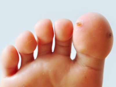 Verrucae (Plantar Warts) image - the underside of a toe