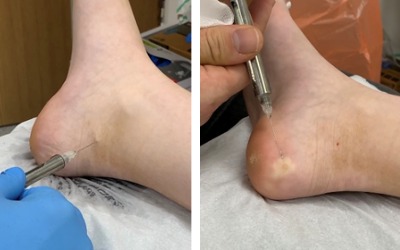 stage of severe verrucae (Plantar Warts) removal