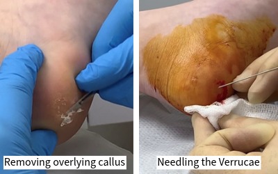 stage of severe verrucae (Plantar Warts) removal