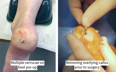 Verruca treatment in Leeds. Treatment of severe verrucae (Plantar Warts) removal