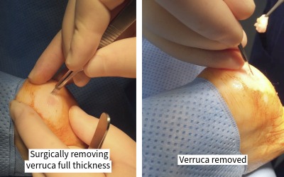 stage of severe verrucae (Plantar Warts) removal