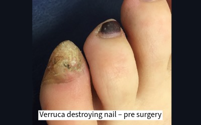 4 weeks post Verrucae (Plantar Warts) removal