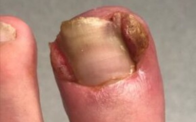 Ingrowing Toenail Treatment in Leeds