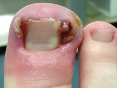 Ingrowing Toenail Treatment in Leeds