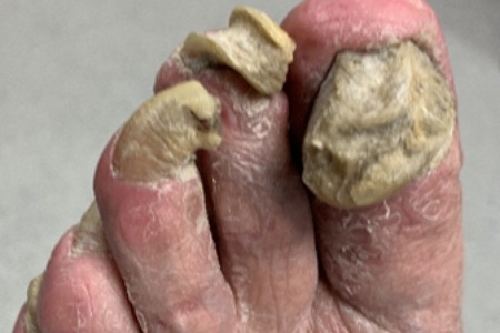 Thickened nail. Ingrowing Toenail Treatment in Leeds