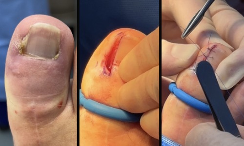 Winograd’s procedure. Ingrowing Toenail Treatment in Leeds