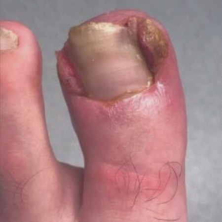 Ingrowing Toenail Assessment and Treatment in Leeds hero image