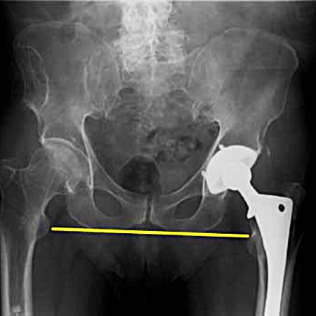 Leg Length Discrepancy Assessment and Treatment in Leeds hero image