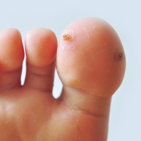 Verrucae (Plantar Warts) Assessment and Treatment in Leeds hero image