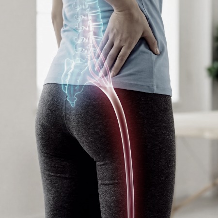 a lady with sciatic pain