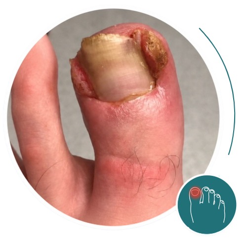 Ingrowing Toenail Assessment and Treatment in Leeds hero image
