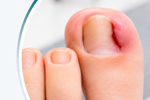 Ingrowing toenail surgery in Leeds