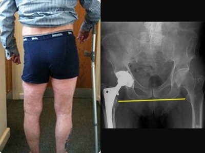 Leg length discrepancy following a femur operation