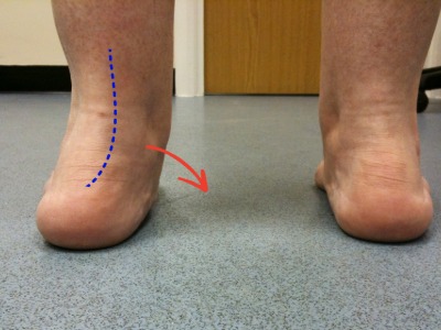 overpronate ankle