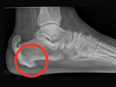 xray of foot with circle highlighting the pain area Heel pain treatment Leeds
