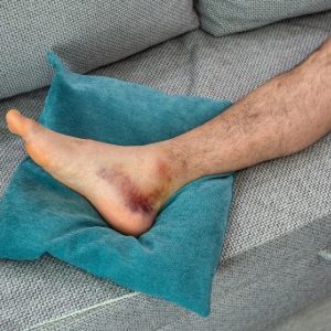 Ankle Sprain bruise