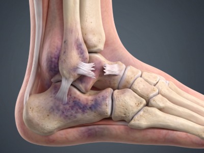 Anatomical 3D rendering of a human ankle joint showing bruised tissues and torn ligaments
by WisChi