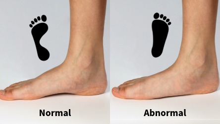 common conditions Flat Foot-