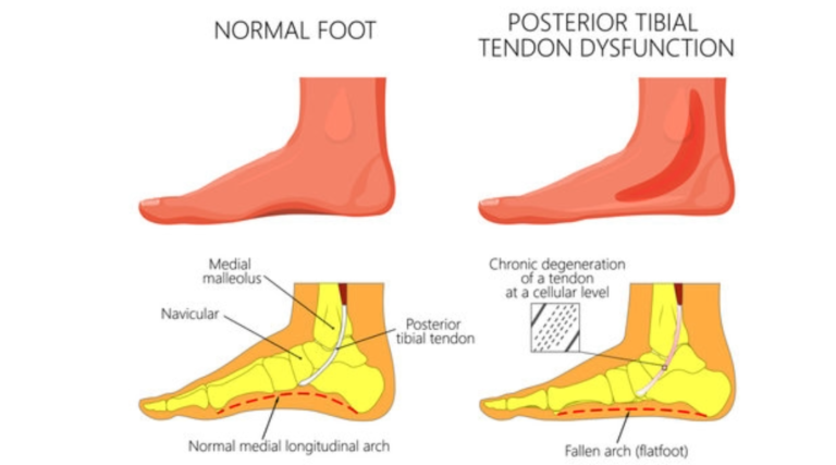 atomically drawn image showing normal and abnormal foot
