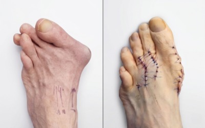 Bunion before and after surgery