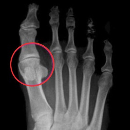 Hallux-limitus- xray