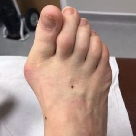BEFORE-Bunion-and-hammer-toe
