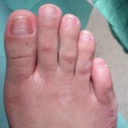 foot-narrowing